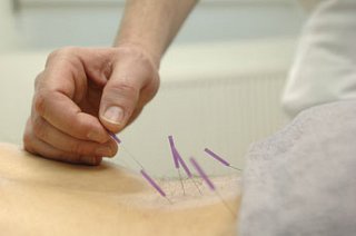 Acupuncture for low back pain