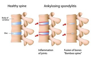 Ankylosing Spondylosis