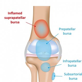 Bursitis Treatment