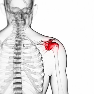 Arthritis in the Shoulder