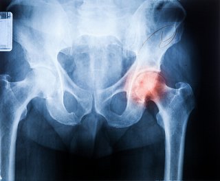 Arthritis and Hip Pain