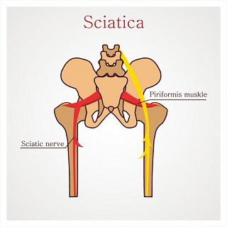 Sciatica Piriformis Muscle