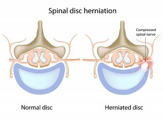 Herniated Disc Surgery